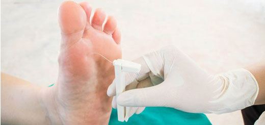Funghi piedi sintomi e trattamento